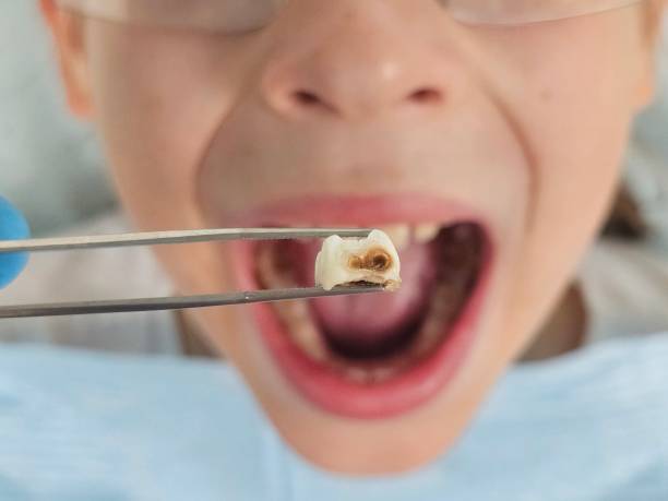 Best Emergency Tooth Extraction in Dry Ridge, KY